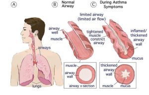 asthma3